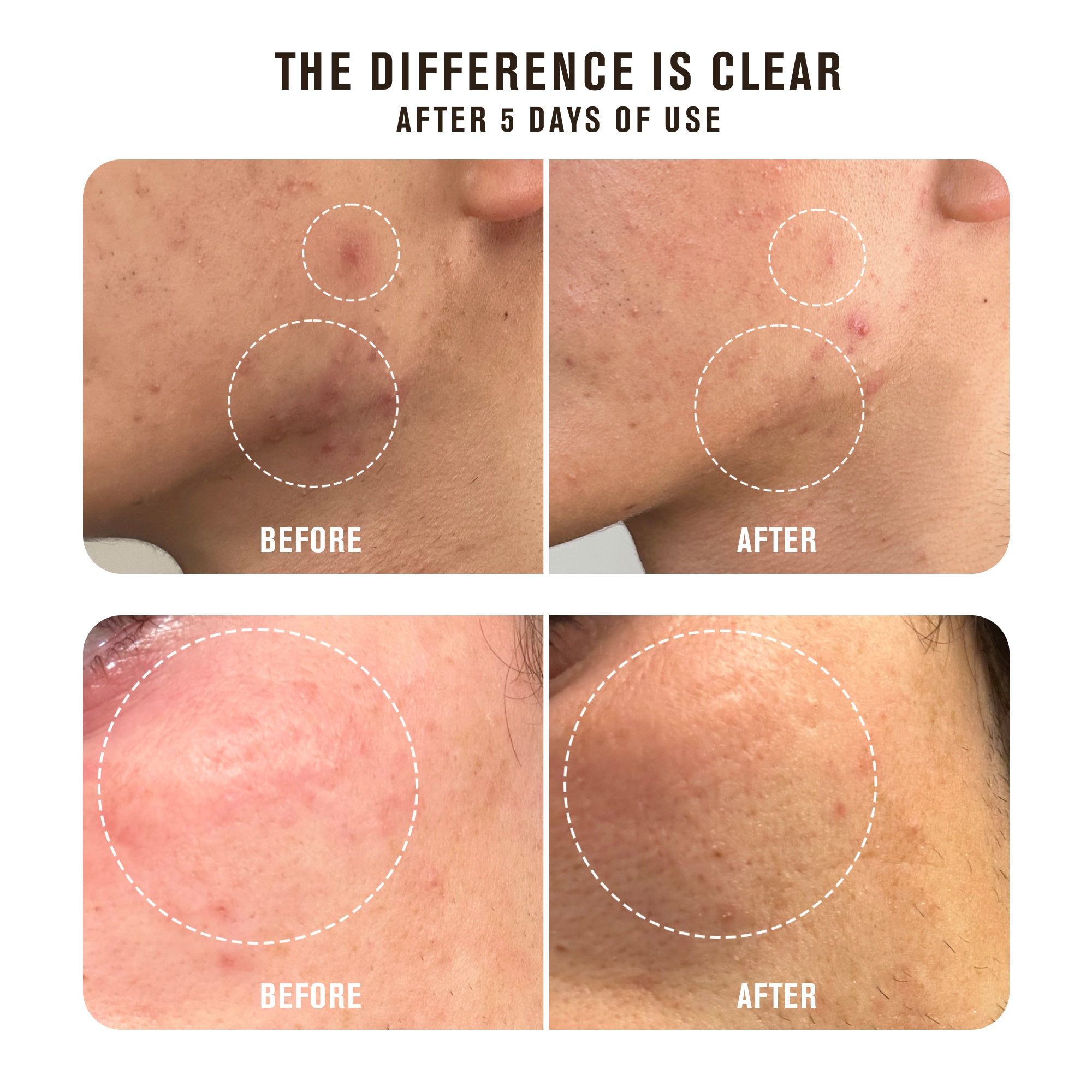 Acne Spot Treatment