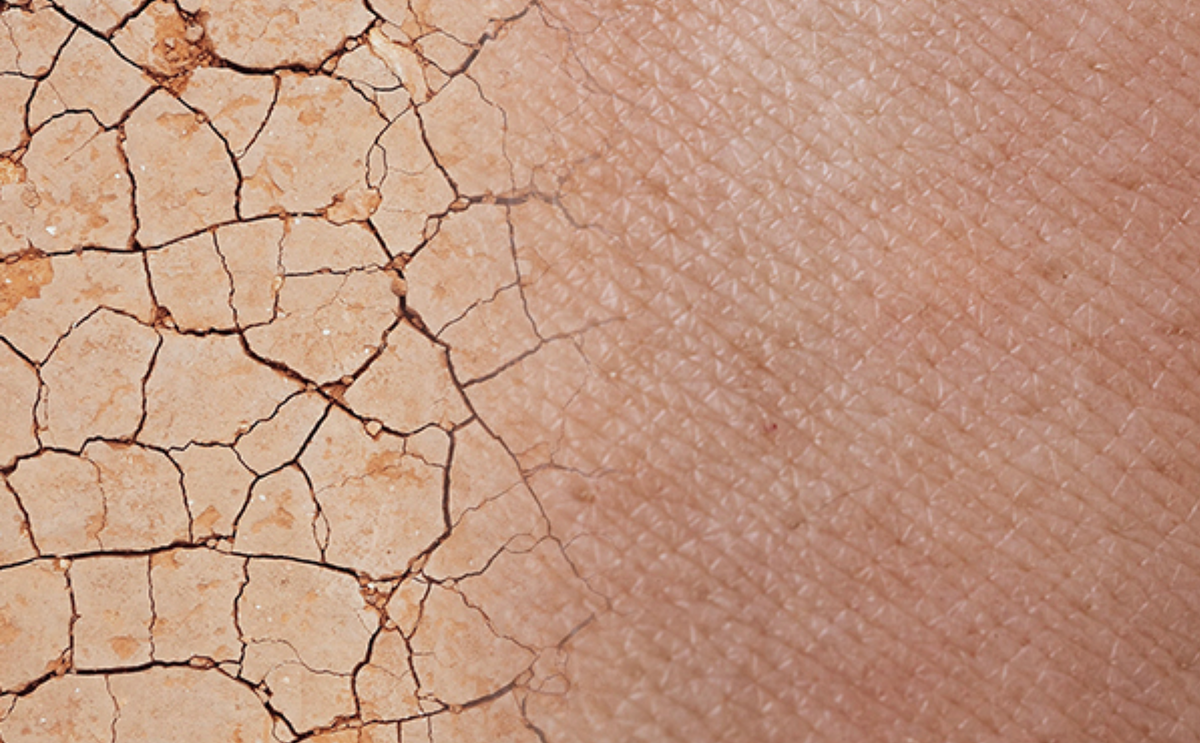 Split view of cracked dry earth and close-up dry facial skin illustrating dehydrated skin
